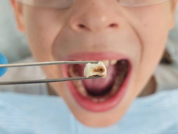 Best Knocked-Out Tooth (Avulsed Tooth) Treatment in Shelburne Falls, MA