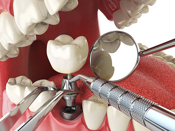 Best Emergency Root Canal Therapy in Shelburne Falls, MA